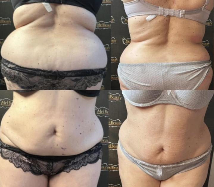 Lipocavitation Rouen