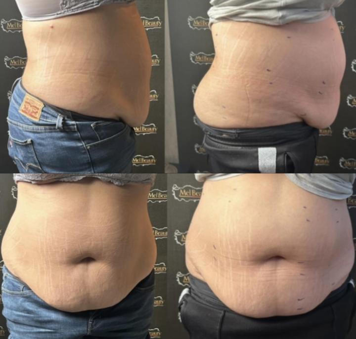 Esthéticienne spécialisée dans la lipocavitation Rouen