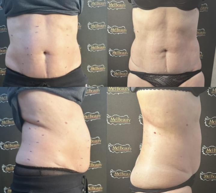 Esthéticienne spécialisée dans la lipocavitation Rouen