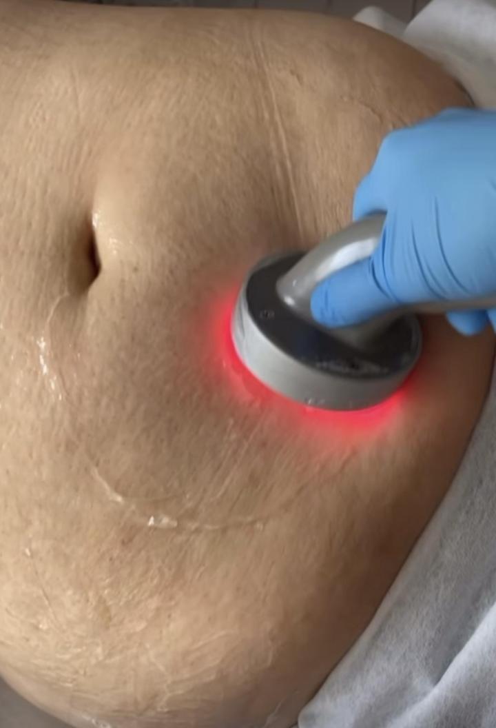 Lipocavitation Rouen