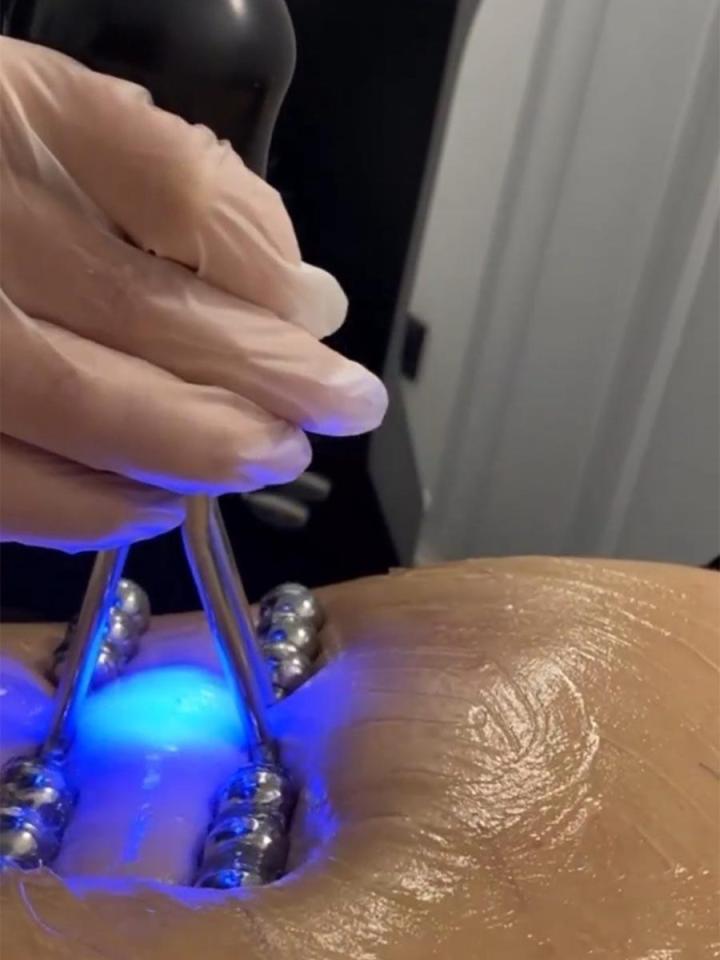 Lipocavitation Rouen