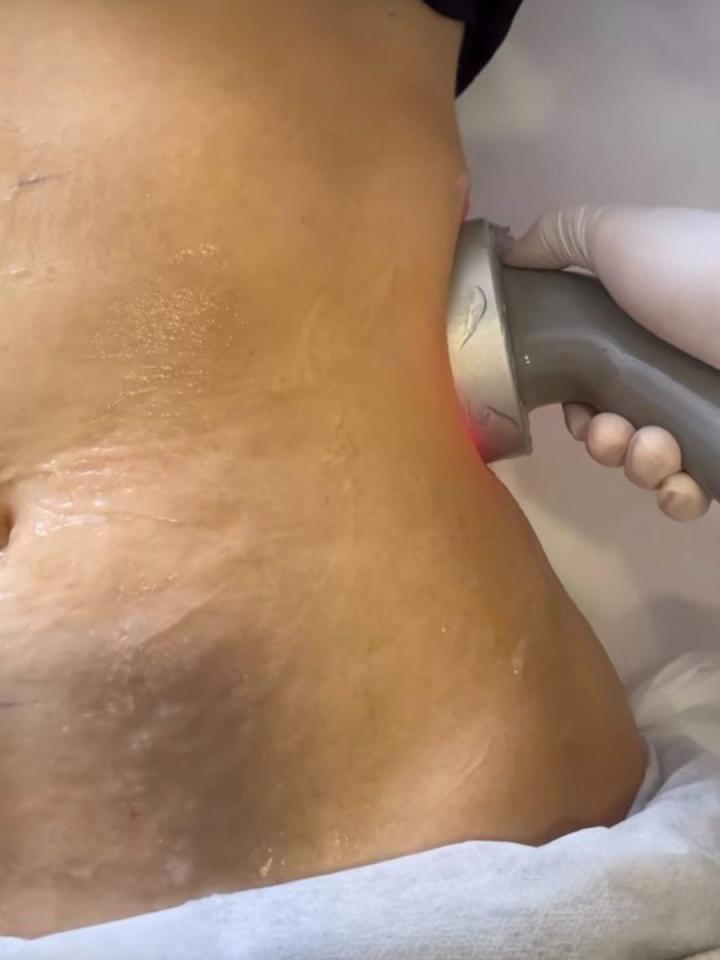Lipocavitation efficace près de Rouen